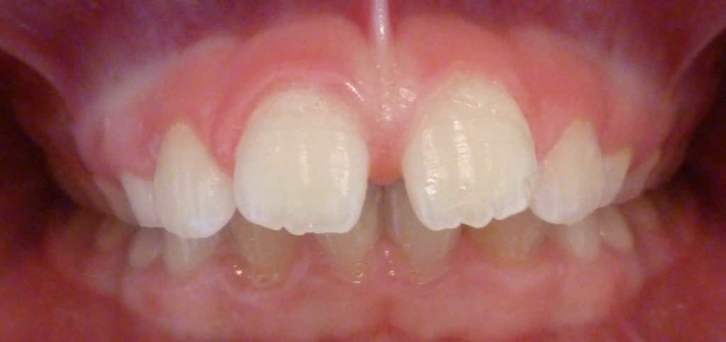 orthodontics before londonderry